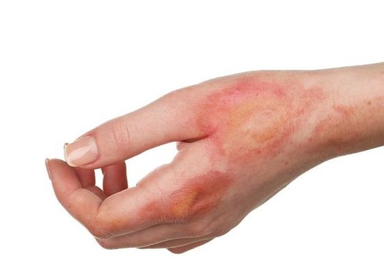 Horrible burns on female hand isolated on white