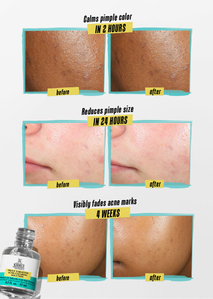 kiehls-acne-spot-truly-targeted-acne-clearing-solution-pdp-content-spot-before-and-after